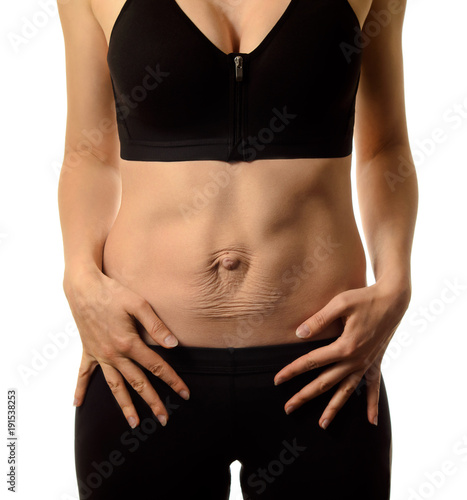 Obraz na płótnie Diastasis recti. Woman's abdomen divergence of the muscles of the abdomen after pregnancy and childbirth. w salonie