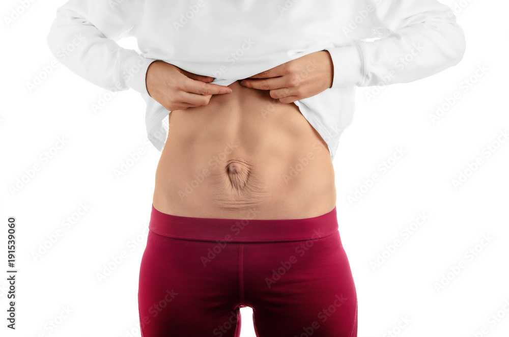 Diastasis recti. Woman's abdomen divergence of the muscles of the abdomen after pregnancy and childbirth.