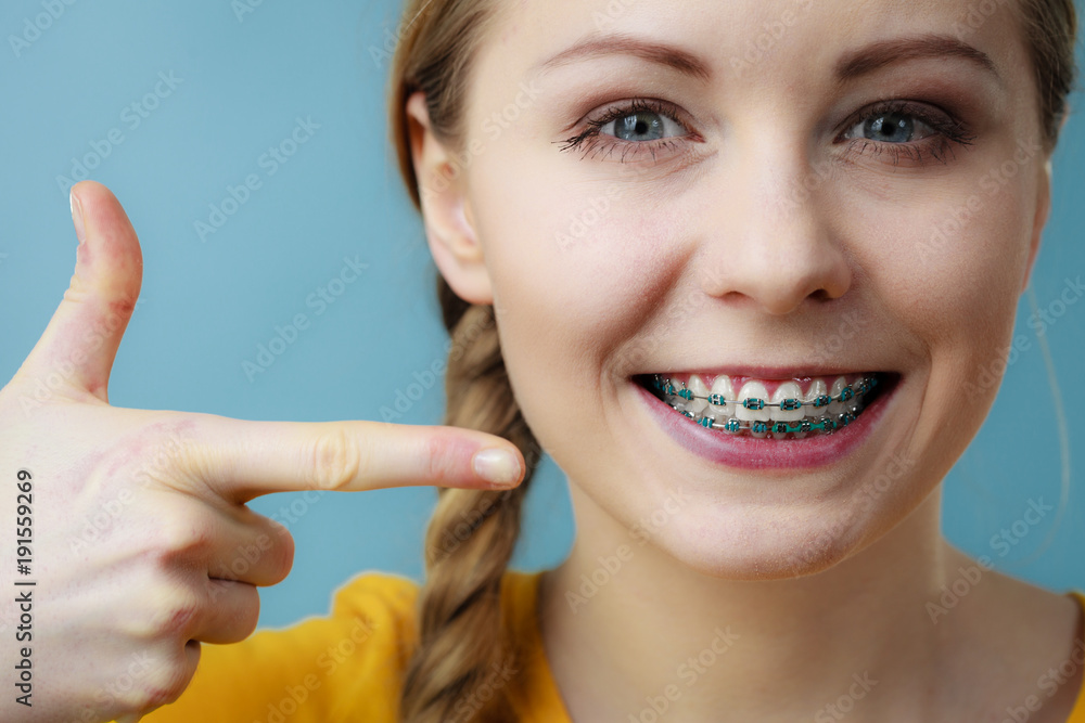 Young woman showing teeth braces Young woman showing teeth braces