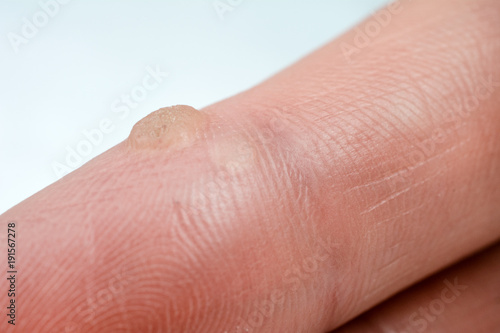wart on the finger verruca freeze concept  blurred neutral background, selective focus