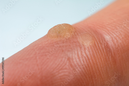 verruca on the finger wart freeze concept  blurred neutral background, selective focus