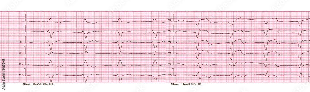 ECG with rhythm of artificial pacemaker (ventricular pacing) ECG with rhythm of artificial pacemaker (ventricular pacing)