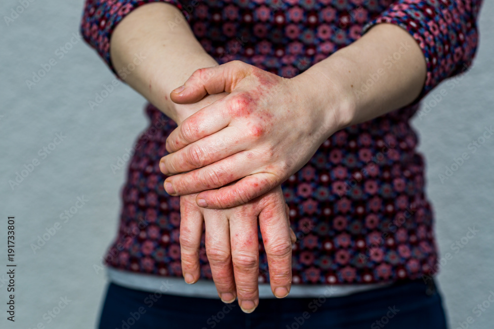 Young woman with dry and stressed red dyshidrotic eczema covered hands