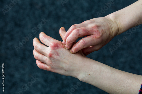 Young woman with dry and stressed red dyshidrotic eczema covered hands photo