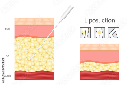 Liposuction before and after , fat , cosmetic . step of Liposuction and icon