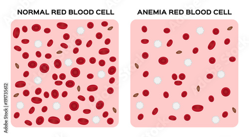 anemia vector / blood anatomy concept