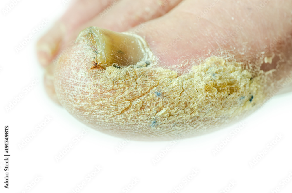 Illustration of a fungal nail infection showing human hand with  onychomycosis and close-up view of Trichopyton rubrum fungi, one of the  causative agents of nail infections Stock Photo - Alamy