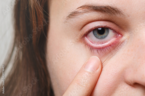 Medicine, health care and eyesight concept. Unrecognizable female shows her inflated red eye with blood capillary, has conjuctivitis. Woman with injured eye photo