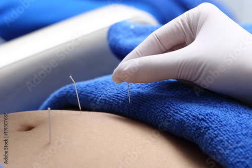 Close up Hand Perform Medical of professional acupuncture treatment in Beauty spa on body, stomach, legs, hands, face, cheek, forehead from expertise beautician from Chinese Needle, concept anti aging