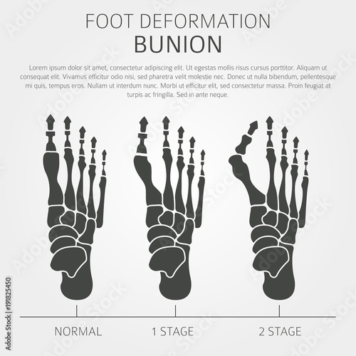 Foot deformation as medical desease infographic. Causes of bunion
