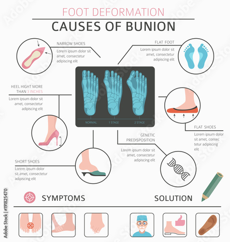Foot deformation as medical desease infographic. Causes of bunion
