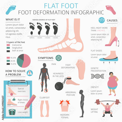 Foot deformation as medical desease infographic. Causes of Flat foot