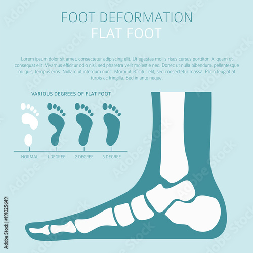 Foot deformation as medical desease infographic. Causes of Flat foot