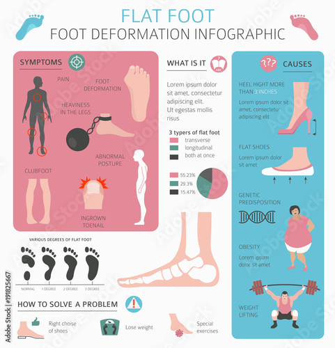 Foot deformation as medical desease infographic. Causes of Flat foot