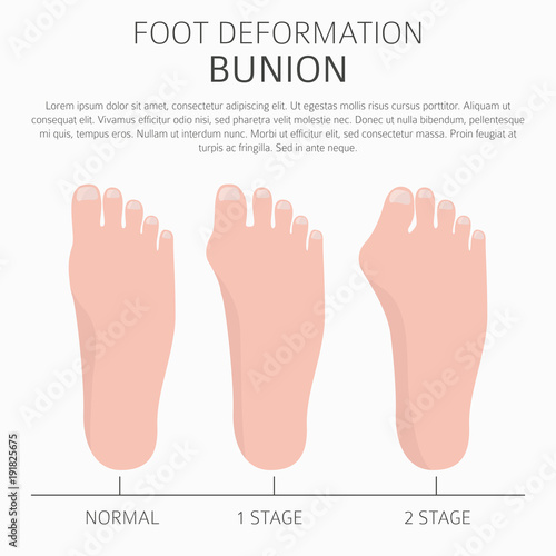 Foot deformation as medical desease infographic. Causes of bunion
