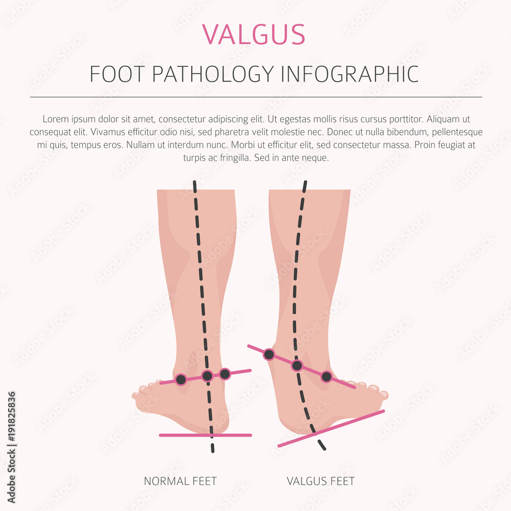 Foot deformation as medical desease infographic. Valgus and varus