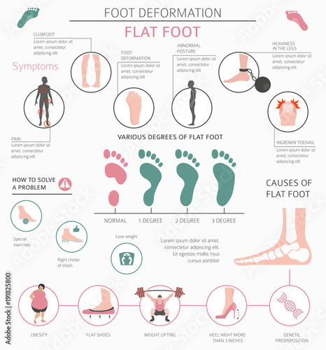 Foot deformation as medical desease infographic. Causes of Flat foot