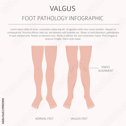 Foot deformation as medical desease infographic. Valgus and varus defect