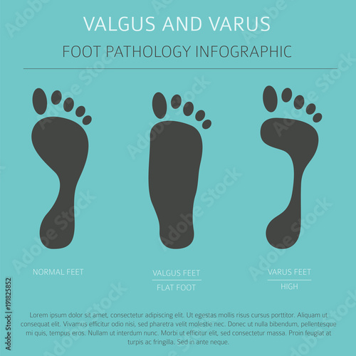 Foot deformation as medical desease infographic. Valgus and varus defect