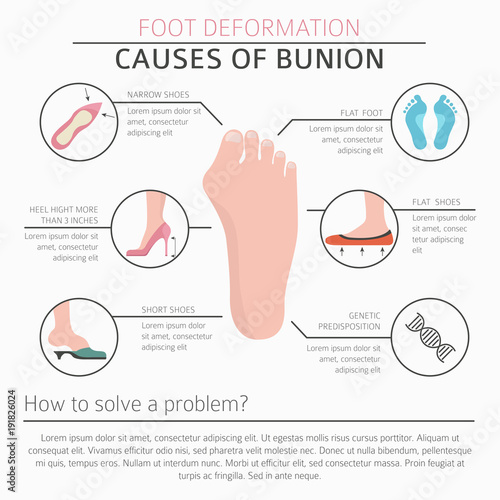 Foot deformation as medical desease infographic. Causes of bunion