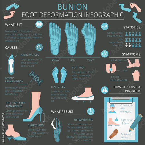 Foot deformation as medical desease infographic. Causes of bunion