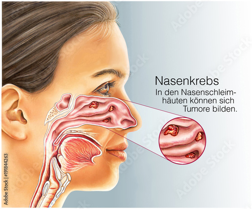 Schilderij op canvas Nasenkrebs.Geschwüre