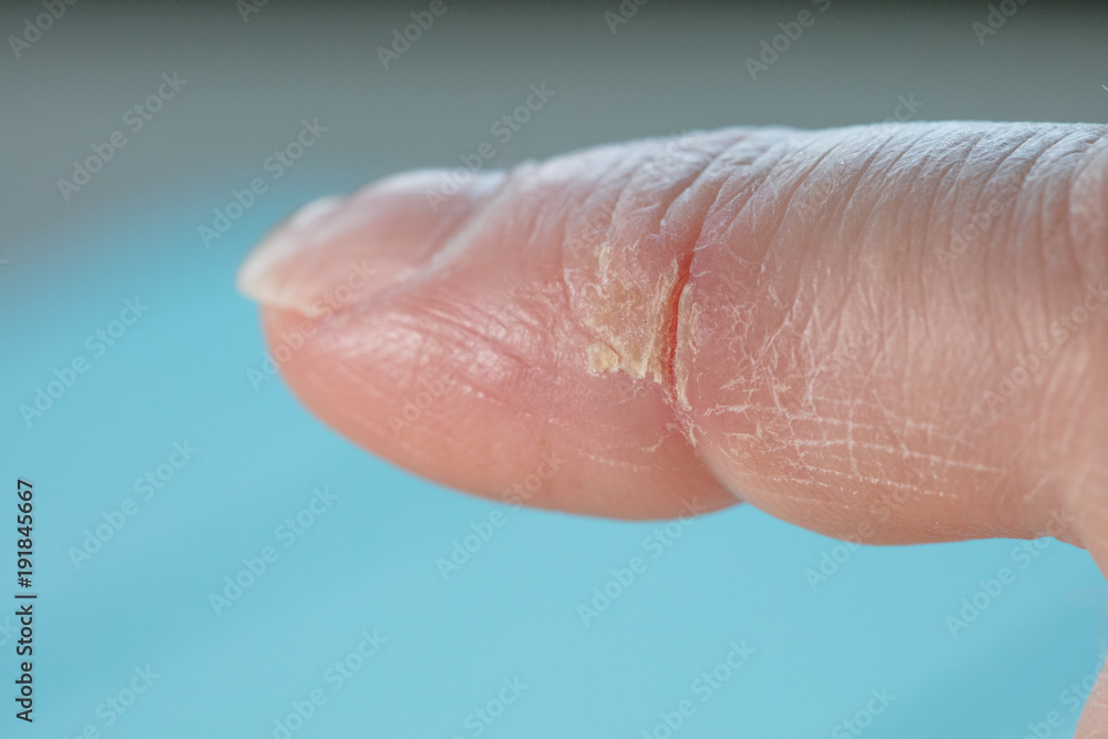 Fototapeta premium cold cut on index finger