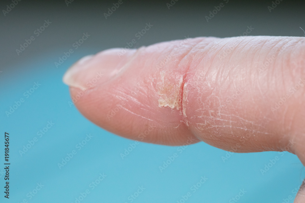 Fototapeta premium cold cut on index finger