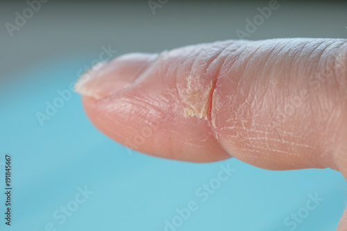 cold cut on index finger