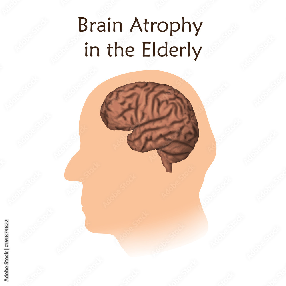 atrophy brain
