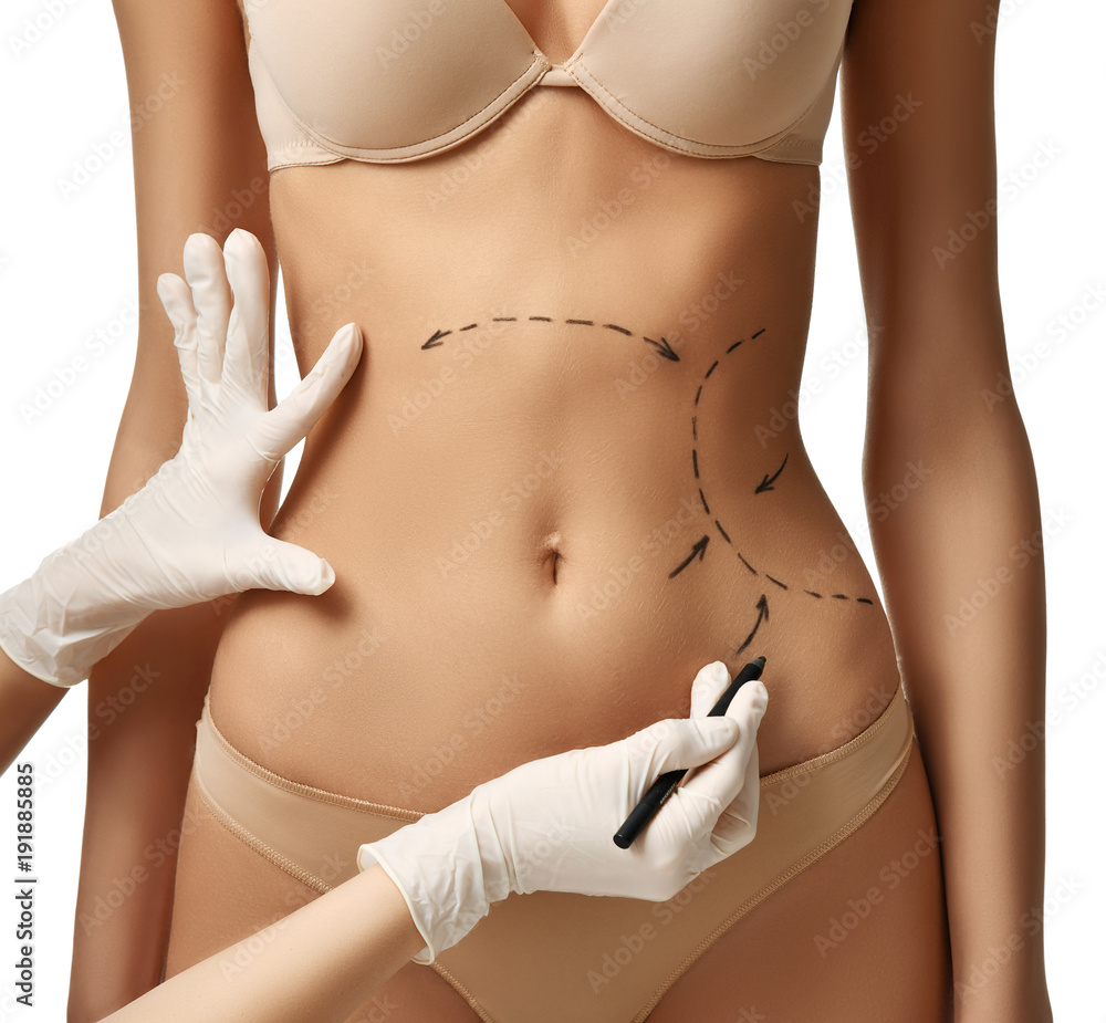 Female body with the drawing arrows on tummy for plastic surgery liposuction