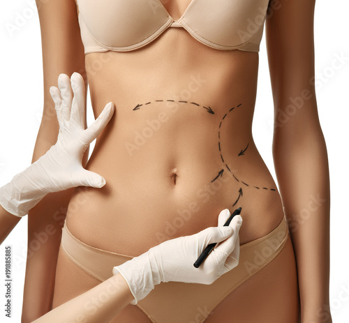 Female body with the drawing arrows on tummy for plastic surgery  liposuction 