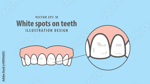 White spots on teeth illustration vector on blue background. Dental concept.