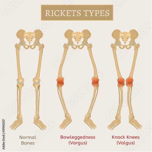 Vector Rickets Scheme