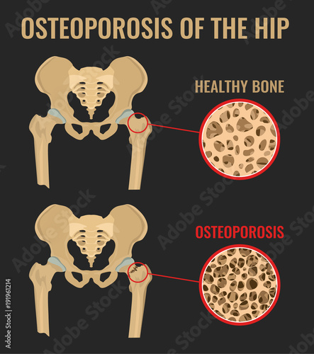 Osteoporosis of the Hip