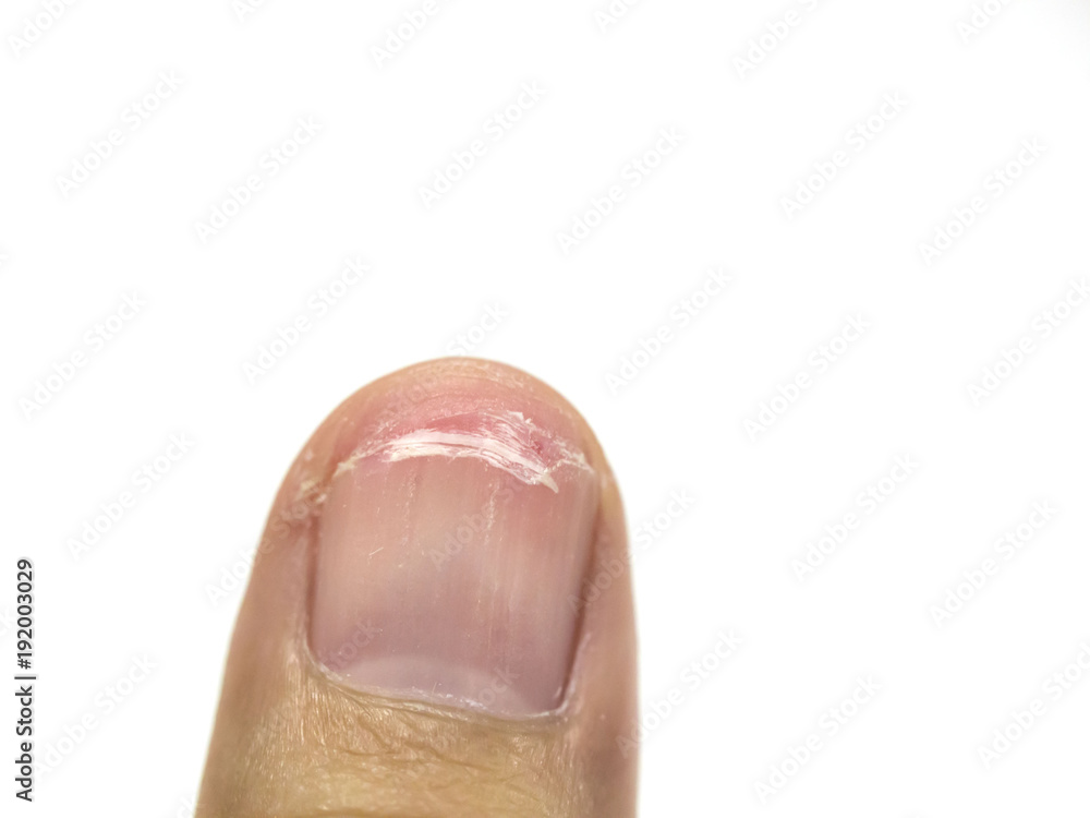 .Shred nails show bad nail health. Lack of vitamins and calcium And should use nail clippers cut should not be pulled out. .Shred nails show bad nail health. Lack of vitamins and calcium And should use nail clippers cut should not be pulled out.