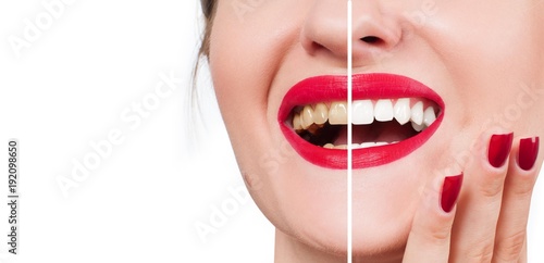 White teeth and red lips. Perfect female smile after whitening teeth.