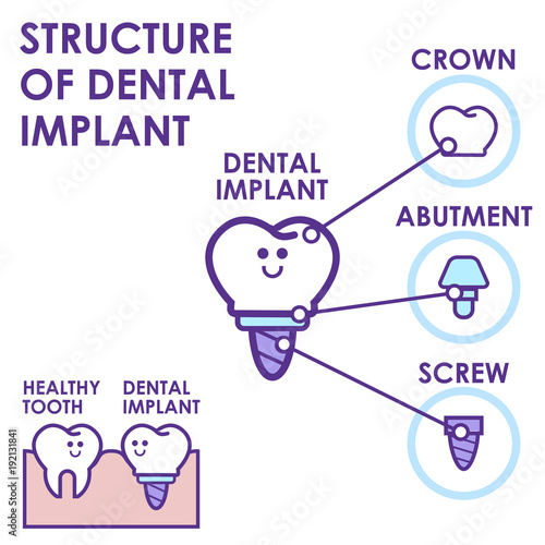 Dental implant structure medical pictorial educative infographic poster with molar replacement end healthy tools models vector illustration