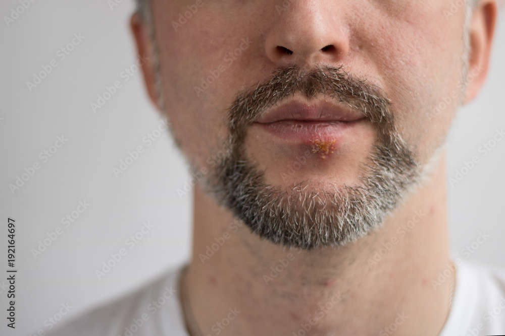 Obraz premium Medicine Illness Herpes Man Beard Healthy