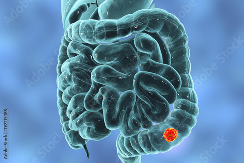 Quadro em tela Colorectal cancer awareness medical concept, 3D illustration showing cancerous t