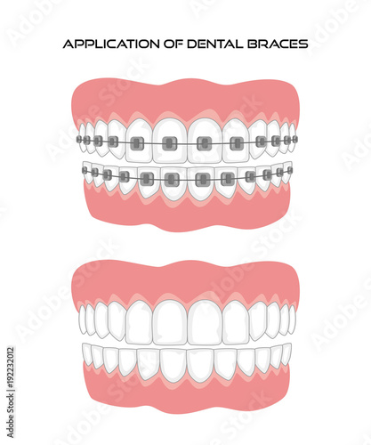 Teeth with braces on white background.