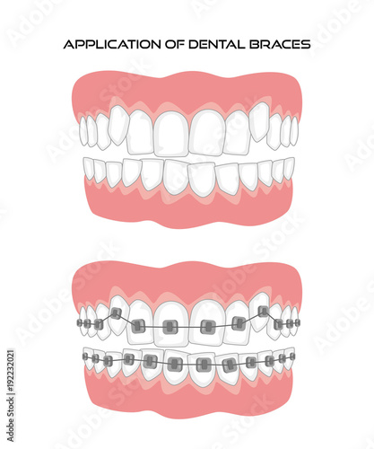 Teeth with braces on white background.
