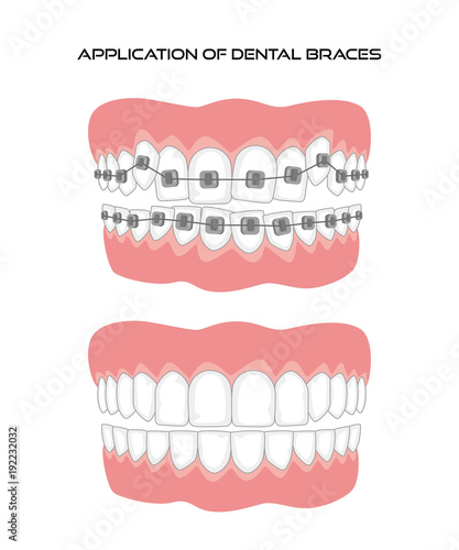 Teeth with braces on white background.