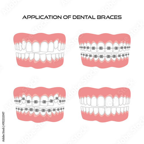 Teeth with braces on white background.
