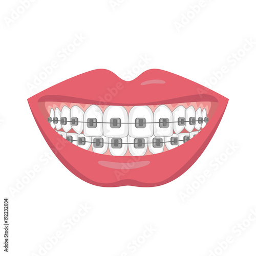 Teeth with braces on white background. photo
