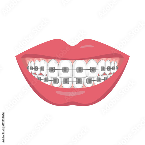 Teeth with braces on white background.