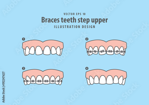 Braces teeth step upper illustration vector on blue background. Dental concept.