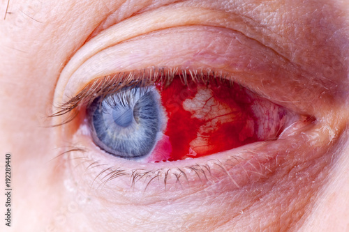 Bloodshot eye. Close-up macro image of a very red bloody eyeball. photo