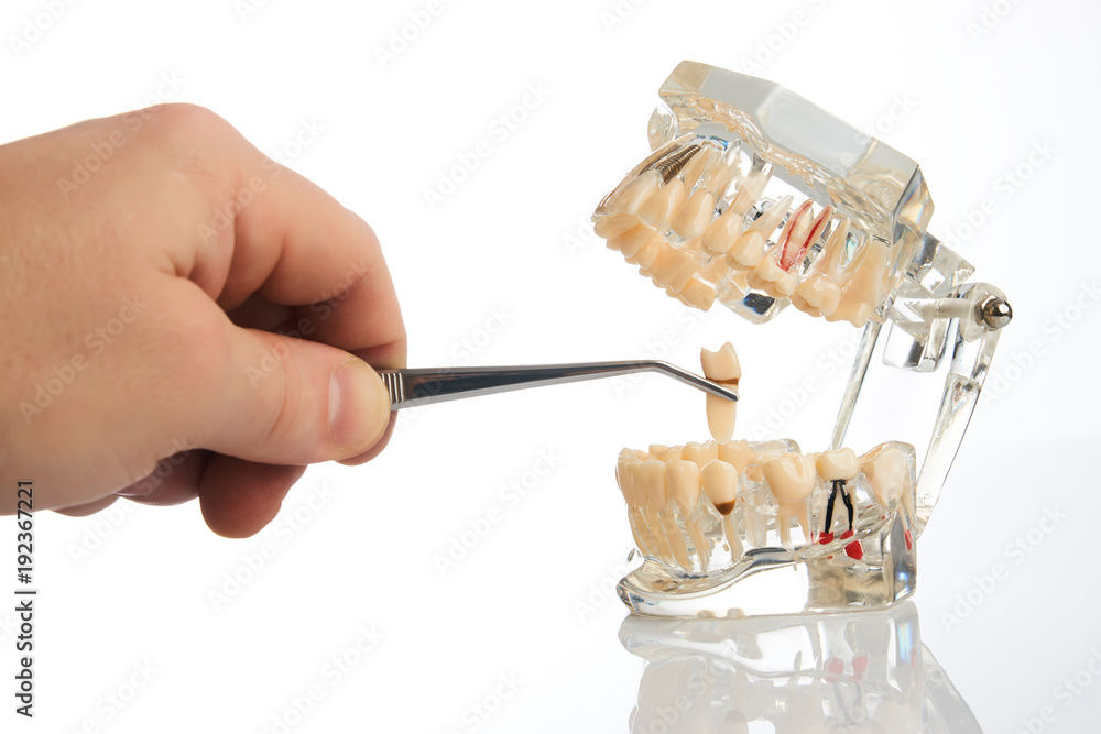 Dentist hands pulls out a tooth with dental forceps from jaw model over