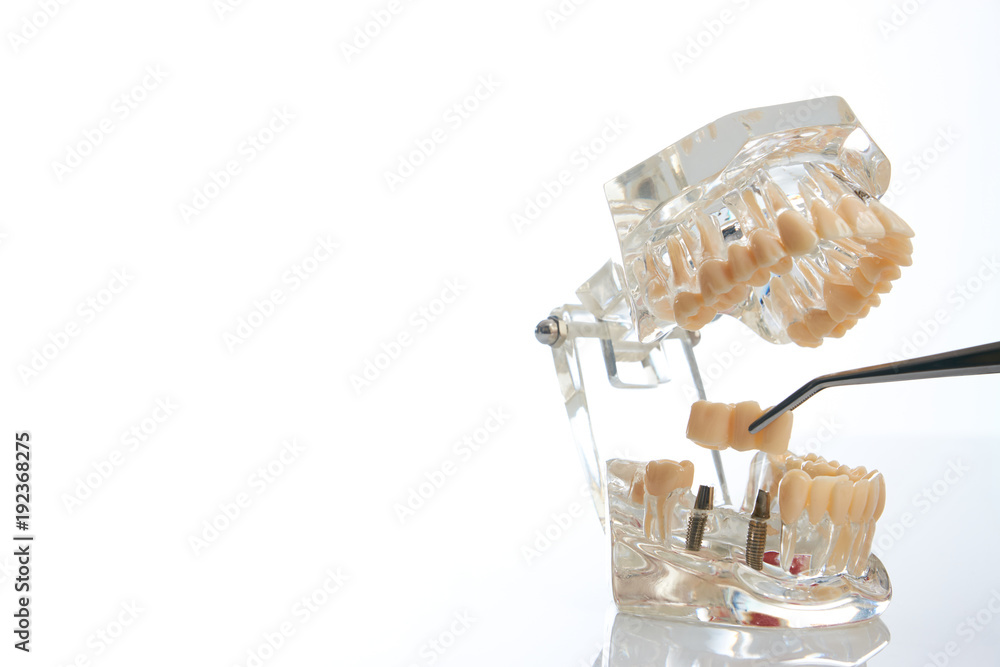 Dental technician placing the fixed partial denture, dental bridge on the screw implants, close-up. Dentists tooth model with screw implant for teaching, learning showing teeth and gums